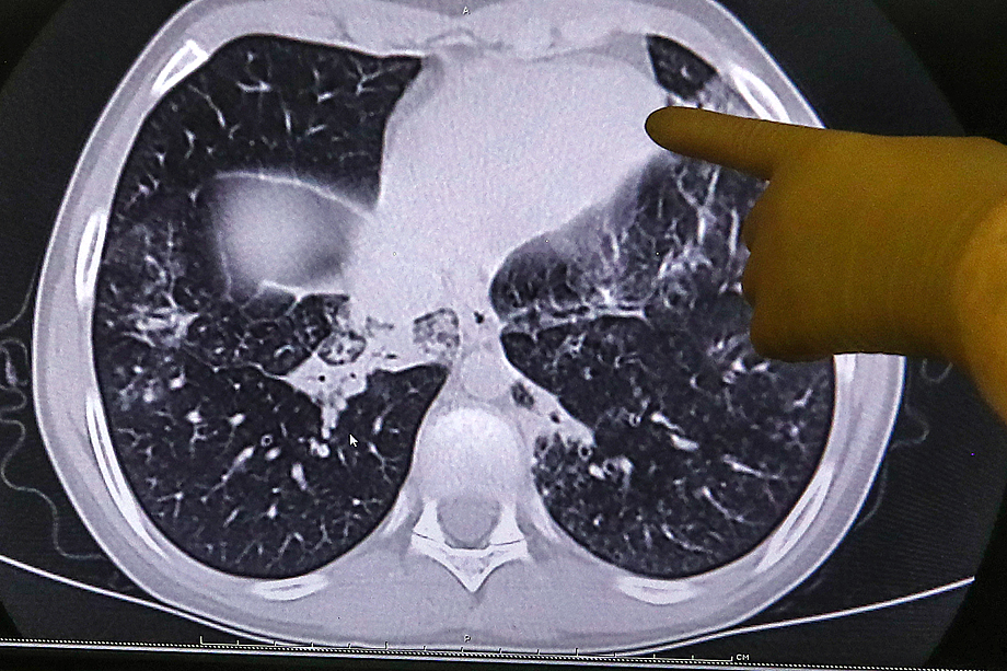 Клиническая картина COVID-19 при поражении лёгких: скопление жидкости, которая препятствует прохождению воздуха и снабжению кислородом.