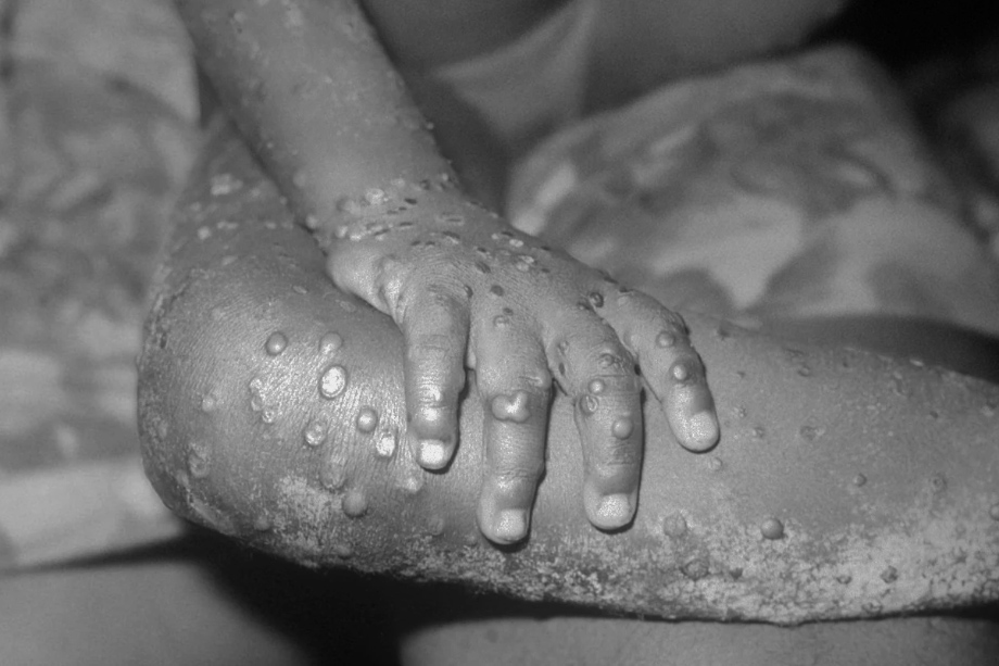 1971 год. Очаги обезьяньей оспы на коже ребёнка в Либерии.